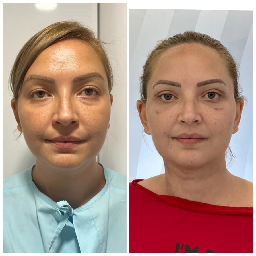 Blefaroplastie totala + cantipexie