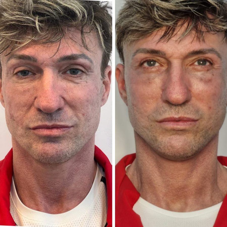 Blefaroplastie totala + facelift