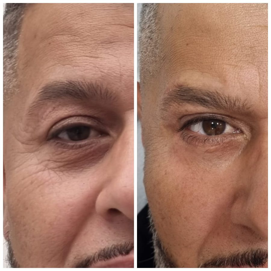 Blefaroplastie totala + lifting de sprancene